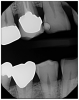 Figure 6. Thin enamel, flat cusps and bone
resorption.