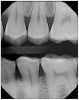 Figure 7. Thin enamel and flat mandibular cusps with widening of the periodontal ligament on tooth #13.