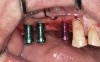 Fig 11. Dental implants are inserted through the crestal osteotomy preparation.