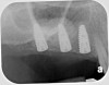 Fig 14. Peri-apical X-ray of the site immediately following sinus floor elevation and implant insertion.