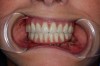Fig 1. A mandibular immediate fixed hybrid fabricated through denture conversion used as an interim prosthesis while integration and tissue maturation occurs.