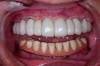 Fig 2. Wear and discoloration can be seen over time; fixed hybrid restorations made of denture teeth and acrylic.