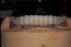 Fig 7. The use of a micro-hybrid composite veneered framework drastically reduced the amount of vertical height needed to accommodate a traditional acrylic hybrid with denture teeth.