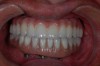 Fig 9. An implant retained over-denture was upgraded to a fixed zirconia hybrid.