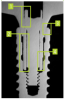 Fig 10. Cross-sectional illustration of an original, authentic implant-crown complex demonstrating an intimate contact, proper channel length within the abutment, and ideal engagement of the Morse taper above the screw (1-4).