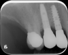 Fig 14. Radiograph showing an authentic implant/abutment complex at tooth No. 4 and an incompatible implant/abutment complex at tooth No. 5, where the entire preload is on the screw.