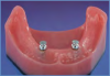Figure 4. Impression copings placed over abutments.