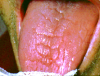 Fig 1. Fissured/lobulated tongue.
