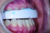 Fig 3. Interim dental splint used to help minimize inflammation and stress in the joints and muscles.