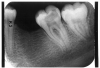 Figure 3 - Dentin Caries