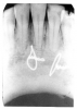 Figure 25 - Callus at Healed Fracture Site