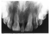 Figure 27 - Mesioden seen in radiographic image
