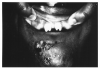 Figure 32 - Hutchinson’s Teeth