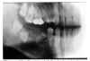 Figure 43 - Regional Odontodysplasia