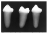Figure 44 - Dentinogenesis Imperfecta
