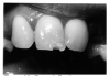 Figure 48 - Turner’s Tooth