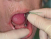 Figure 18. Removal of healing abutments.