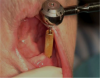 Figure 20. Implant being torque to the correct level.
Photos courtesy of John Bain DDS