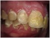 Fig 10. Accumulation of soft plaque is typical of oral hygiene neglect associated with the use of methamphetamine.