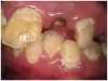 Fig 11. Note demineralization of smooth surfaces, carious lesions at the gingival margins, and associated inflammation of the periodontium.