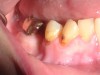 Fig 13. Smooth-surface caries in a methamphetamine-using patient.
