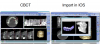 Figure 8. When CBCTs are combined with IOS data files, a more precise evaluation of the patient’s oral structures can be performed for implant placement and treatment planning.