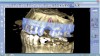 Figure 9. By merging CBCT files with IOS files and using implant planning software, dental professionals can plan all components of the implant/restoration procedure in advance for a restoratively driven approach: CBCT, IOS, and CAD merged and overlayed as one (Fig 9); implant placement and implant guide CAD (Fig 10).
