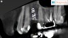 Figure 10. By merging CBCT files with IOS files and using implant planning software, dental professionals can plan all components of the implant/restoration procedure in advance for a restoratively driven approach: CBCT, IOS, and CAD merged and overlayed as one (Fig 9); implant placement and implant guide CAD (Fig 10).