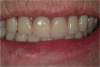 Figure 28. After denture is seated, occlusion is confirmed.