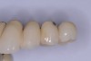 Fig 1. Chipping of veneering porcelain of porcelain-fused-to-gold full-arch fixed dental prosthesis.