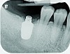 Fig 6. Radiograph following crown fracture.