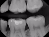Fig 4. Case 1. Bitewing radiograph shows no indication of caries on tooth No. 14.