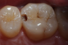 Fig 6. Case 1. Initial opening of tooth reveals caries.
