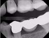 Fig 7. Case 2. Bitewing radiograph shows no indication of interproximal or recurrent caries around the composite restoration on tooth No. 13.
