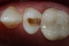Fig 9. Case 2. Initial opening of tooth shows caries into the dentin.
