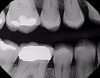 Fig 10. Case 3. X-ray image obstructed by amalgam restoration.