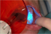 Figure 29. Denture caps being light-cured.