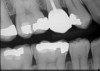 Fig 8. Postcementation radiograph.