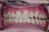 Figure 5 and Figure 6. The monolithic milled veneers were characterized and delivered.