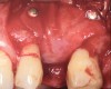 Fig 23. Peri-implant defect filled with a bone replacement graft and covered with a bioabsorbable membrane.