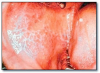 Fig 6. Lichen planus.