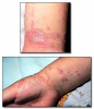Fig 7. Skin lesions of lichen planus.