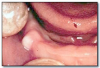 Fig 14. Gingivial cyst of newborn.