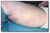 Fig 16. Neurofibromatosis.