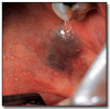 Fig 18. Hemangioma.