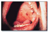 Fig 24. Oral melanotic macule.