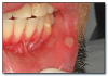 Fig 31. Aphthous ulcers.