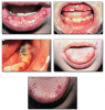 Fig 34. Images of primary herpetic gingivostomatitis.