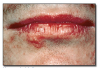 Fig 36. Herpes labialis.
