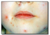 Fig 37. Varicella (chickenpox).